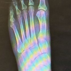 Graff Foot, Ankle and Wound Care - Foot after surgery