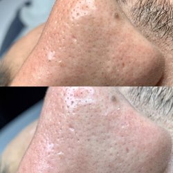 EXTRACTIONS- it's important to remove blackheads so it's doesn't result in enlarged pores