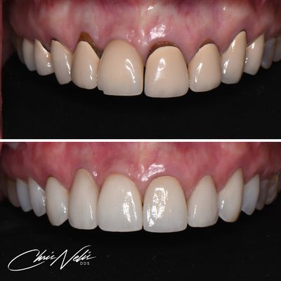 Before and After's - These cases help patients improve the self confidence and provide them with the smile of their dreams. At Christopher Nelis, DDS we offer a full range of services including cosmetic options as well as tooth replacement to restore function. Before and After's - These cases help patients improve the self confidence and provide them with the smile of their dreams. At Christopher Nelis, DDS we offer a full range of services including cosmetic options as well as tooth replacement to restore function.