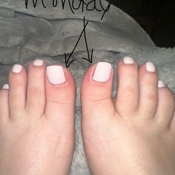 Le Nails Spa - Swollen, sore and inflamed big toes - Nail Salons Near Me - Vacaville, California