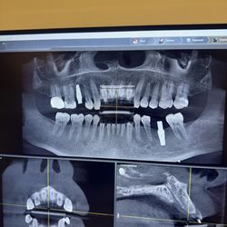Milner Bruce Dds - Xray if my head and new implants!