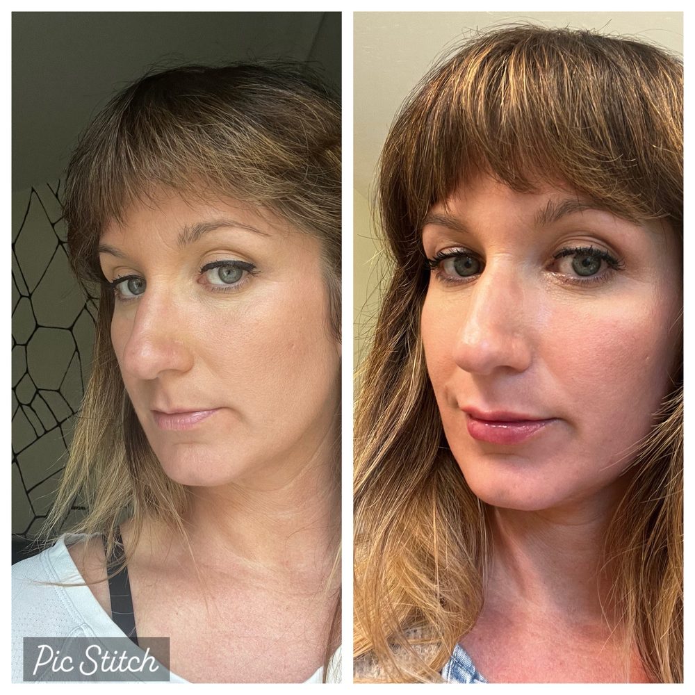 Iconic Plastic Surgery - Before and Immediately After Filler with Dr. Dsouza (20% swollen) - Cosmetic Surgeons Near Me - Carlsbad, California