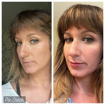 Iconic Plastic Surgery - Before and Immediately After Filler with Dr. Dsouza (20% swollen) - Cosmetic Surgeons Near Me - Carlsbad, California