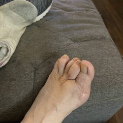 Alabama Family Foot Clinic - Before surgery, if anything - no change! Foot still messed up & today is 10/10/2025!