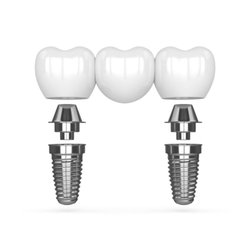 Brandywine Dentures and Implants - Multi-Tooth Dental Implants