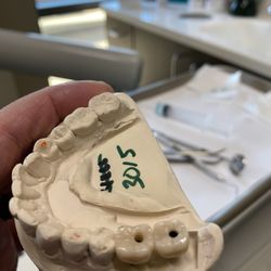 Clear Choice Riverside - After sending my two implants back to the lab for adjustments we will see if they now fit without any issues.