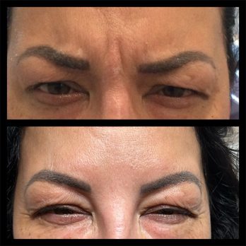 Veritas Backstage - Before and after dysport - Medical Spas Near Me - Austin, Texas