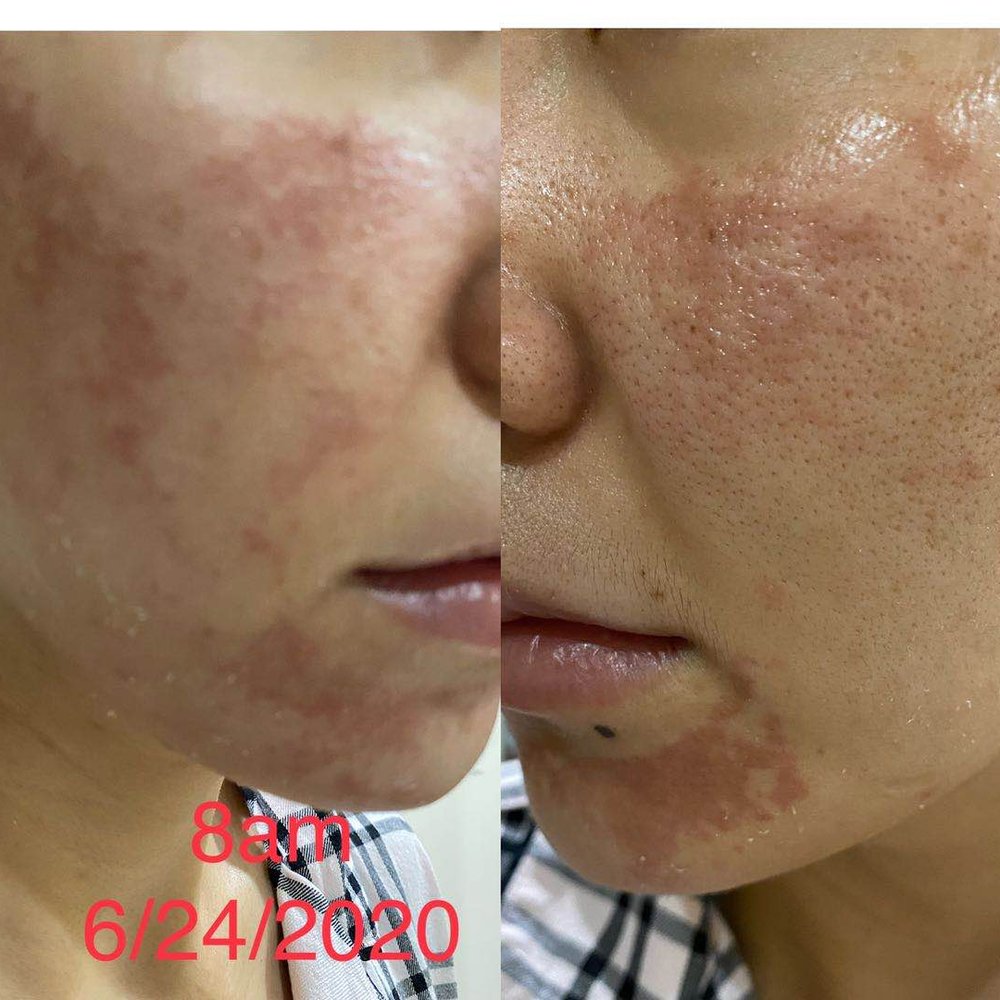 AMCC BEAUTY - Chemical Burn with numbing cream. AMCC is Negligent, not checking up on their clients - Skin Care Near Me - Arcadia, California AMCC BEAUTY - Chemical Burn with numbing cream. AMCC is Negligent, not checking up on their clients - Skin Care Near Me - Arcadia, California