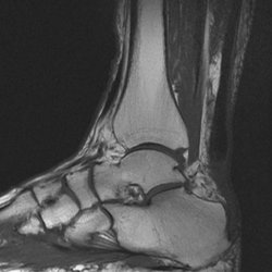 Brian Peternell, DO - Achilles-tendon-tear-PRP-Platelet Rich Plasma Maui