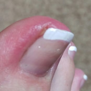 ABC Nail & Spa - My now infected toe, after coming to ABC nails. - Nail Salons Near Me - Tulsa, Oklahoma
