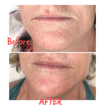 Savvy Skin Spa - Before and after showing decrease in lip lines via Beaty Bomb. - Skin Care Near Me - Solana Beach, California Savvy Skin Spa - Before and after showing decrease in lip lines via Beaty Bomb. - Skin Care Near Me - Solana Beach, California
