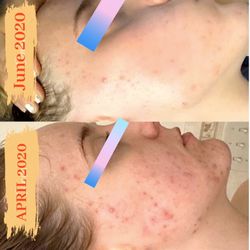 Healing Skin From Within - Before and After virtual client