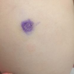 Holistic Veterinary Services - Ringworm that spread to my leg, (has an antifungal on it).