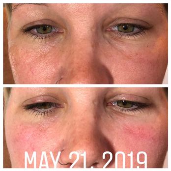Trouvaille Med Spa - Bourbonnais - Filler correction to undereye "bags" - Body Contouring Near Me - Bourbonnais, Illinois Trouvaille Med Spa - Bourbonnais - Filler correction to undereye "bags" - Body Contouring Near Me - Bourbonnais, Illinois