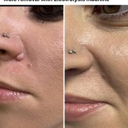 Dallas Institute of Electrolysis - Mole removal