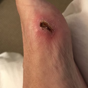 Q Nails and Spa - This is 2 weeks after the initial injury. - Nail Salons Near Me - Sandy Springs, Georgia