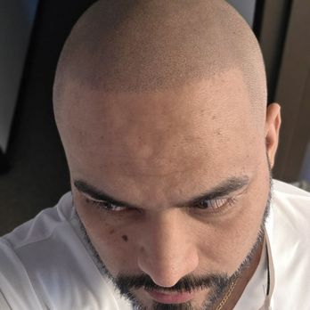 Scalp Society - 3 months later im still very happy with the results. It looks natural and still getting compliments from friends. - Hair Loss Centers Near Me - San Jose, California Scalp Society - 3 months later im still very happy with the results. It looks natural and still getting compliments from friends. - Hair Loss Centers Near Me - San Jose, California