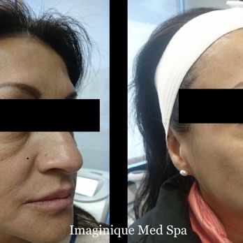 Imaginique Med Spa - Pre & Post Skin Tightening - Laser Hair Removal Near Me - Richardson, Texas Imaginique Med Spa - Pre & Post Skin Tightening - Laser Hair Removal Near Me - Richardson, Texas