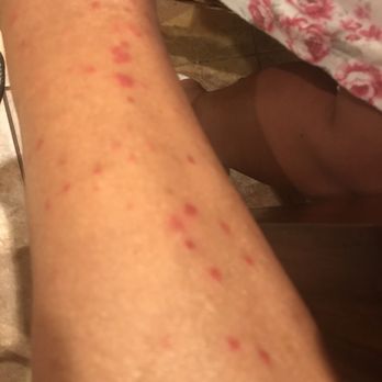 The Normandy Hotel - My legs after staying at the Normandy Hotel October the 7th. No one ever picked up my call horrible customer service. - Hotels Near Me - Washington, DC, District of Columbia