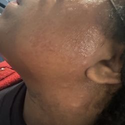 Heena Boutique And Salon - Chemical burns from wax
