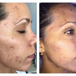 Facial Spa - Acne treatment with Chemical peel and home regimen .