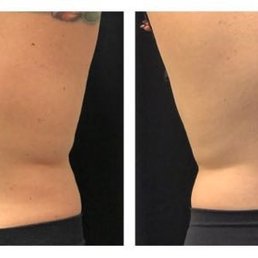One cycle on back area, one on each side, 90 days post procedure
