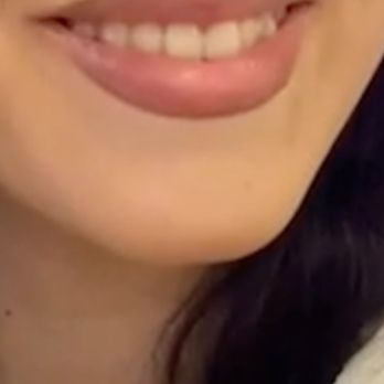 Lavish Lala - Before filler front - Permanent Makeup Near Me - Glendale, California