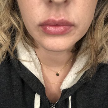 Emerald Aesthetics by Kirin - Day 3, swelling is down and lips are taking their beautiful shape!! - Skin Care Near Me - Gresham, Oregon Emerald Aesthetics by Kirin - Day 3, swelling is down and lips are taking their beautiful shape!! - Skin Care Near Me - Gresham, Oregon