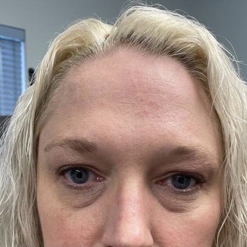 Aesthetic Laser Center - Before - Medical Spas Near Me - Lake Oswego, Oregon Aesthetic Laser Center - Before - Medical Spas Near Me - Lake Oswego, Oregon
