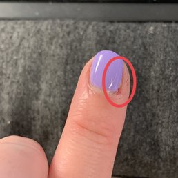 Over clipped index finger Over clipped index finger