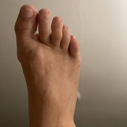 120 Acupuncture Clinic - This is the healed toe!