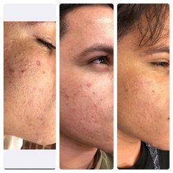 Cosmetic & Laser Center - PRP Acne Scar Treatment- 3 Sessions