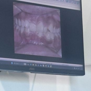 Christopher H Nguyen, DMD, MSD - my teeth when i first started treatment - Orthodontists Near Me - Santa Ana, California