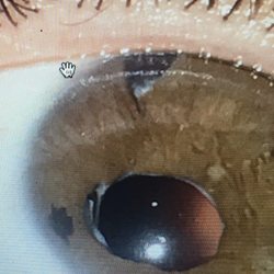 Legally blind eye with foreign objects
