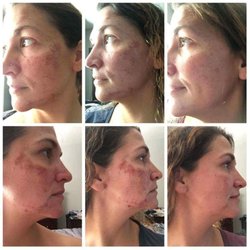 Wink & Wax - 1st, 2nd, and 12th day of a powere peel *results may vary *this was her second power peel * should be done in a series 2-6 for max results