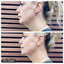 Iconxx Esthetic Lounge - Rf skin tightening treatment
