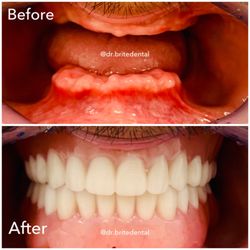 Brite Dental - All-0n-4 Dental Implants restored full mouth aesthetic and function.