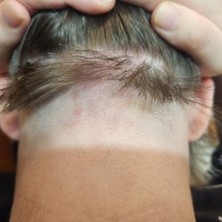 Hair Studio One - Blisters on the back of my daughter's neck Amy French left on her, after she shaved her hairline up over an inch as you can see! NO-NO!