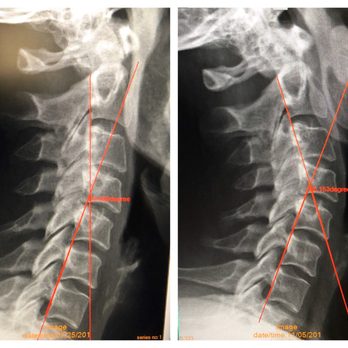 Complete Chiropractic and Rehab - My neck is starting to get its natural curve back! Went from a 20° angle to 36° after 3 months of care (Dr. Nick says the goal is 45°) - Chiropractors Near Me - Evanston, Illinois
