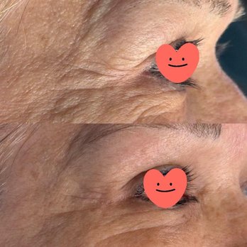 Fibroblast Facelift - Skin Care Near Me - Pasadena, California Fibroblast Facelift - Skin Care Near Me - Pasadena, California
