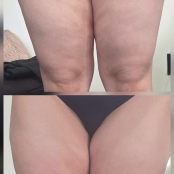 Luxe Body Sculpting - Body Contouring Near Me - Moreno Valley, California Luxe Body Sculpting - Body Contouring Near Me - Moreno Valley, California