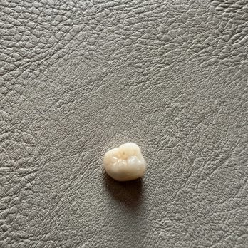 Central Park West Dentistry - Crown that fell out - General Dentistry Near Me - New York, New York Central Park West Dentistry - Crown that fell out - General Dentistry Near Me - New York, New York