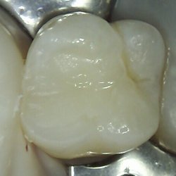 Water Tower Endodontics - After root canal! Looks amazing!