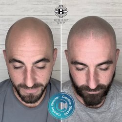 Creative Scalps - Arizona - Keeping a realism scar is a popular choice for many of our clients