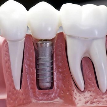 Murphree Dental - General Dentistry Near Me - Ozark, Alabama