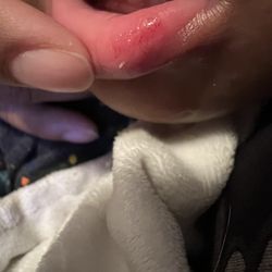 Todays Tomorrow Learning Center - Chipped teeth and bloated lip after taken to the doctor and cleaned . No first aid was provided at the daycare
