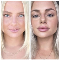 Before  after lip filler