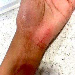 Sliced hand from screw or sharp metal sticking out of pole Sliced hand from screw or sharp metal sticking out of pole