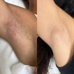 Laser by Nicole - Before and after - Underarms laser hair removal
