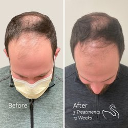 The Skin Center - Hair Restoration with LaseMD Ultra results at The Skin Center.
